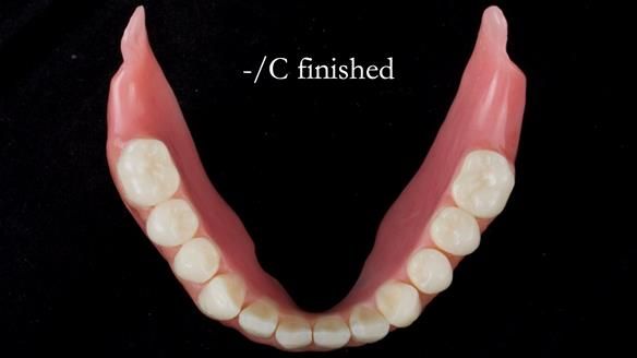 Managing poor implant positioning with complete dentures and Locator attachments - full protocol Newsletter 41