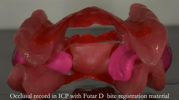 Finlay's Case Study Newsletter 40 - Immediate Mk 1 RPD to Definitive Mk 2 RPD - full protocol
