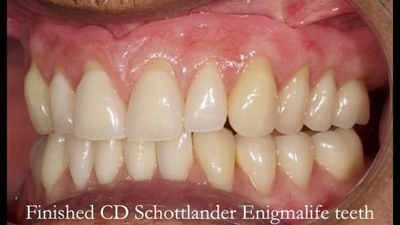 Finlay's Newsletter 62 provision of extractions and metal based complete dentures for Rafique