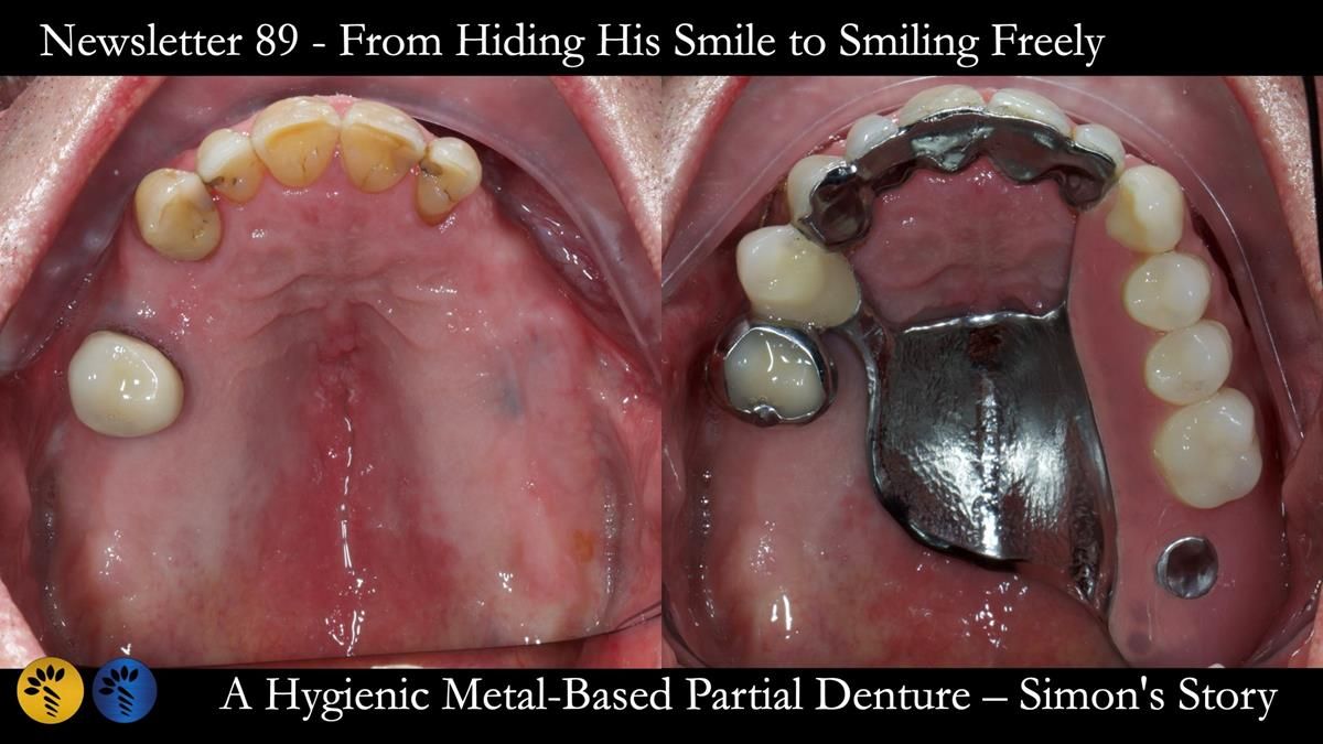 Newsletter 89 – Simon: A Challenging Kennedy Class II Division 1 Upper CoCr Partial Denture with a High Smile Line