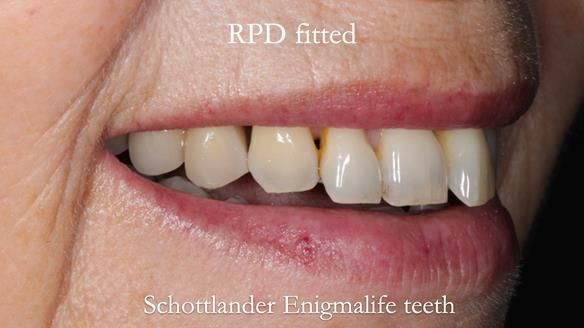 Newsletter 56 showing the making and fitting of a bilateral free end saddle upper removable partial denture (RPD) for patient with pemphigus