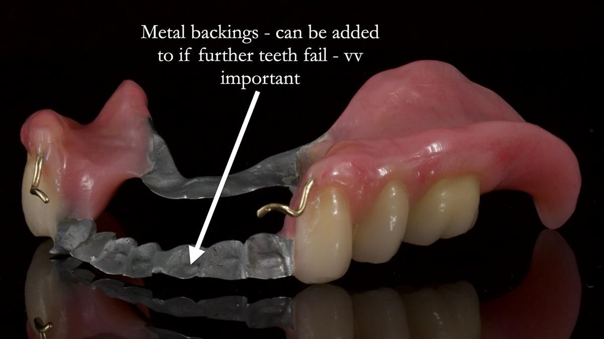 Newsletter 87 – Father Peter: A Partial Denture that needed Minor Miracle