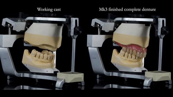 Newsletter 77: Jeremy’s case – immediate complete upper denture