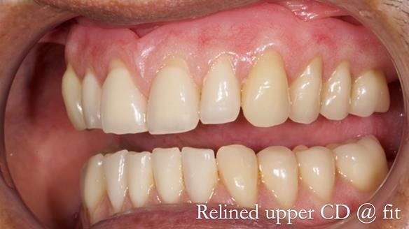 Finlay's Newsletter 62 provision of extractions and metal based complete dentures for Rafique