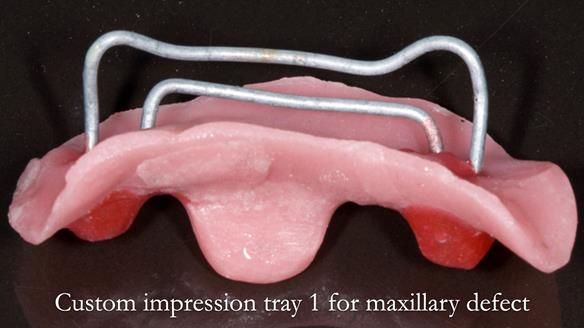 Upper metal base partial denture/occlusal stabilisation splint/obturator - full protocol