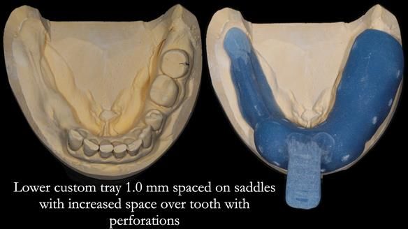 Finlay's Newsletter 61 provision of a lower unilateral free end saddle metal based partial denture for Joyce