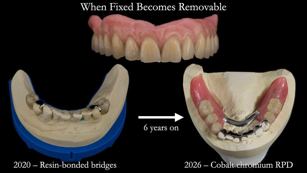Newsletter 87 – Father Peter: A Partial Denture that needed Minor Miracle