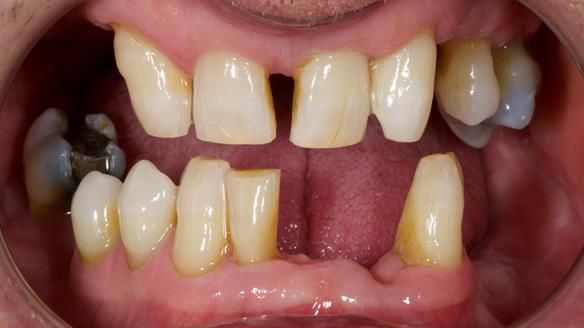 Newsletter 86 Peter the Architect — precision removable partial dentures case study