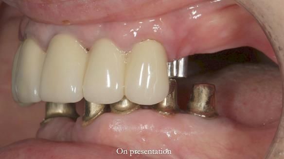 Newsletter 76: Jackie’s case – Telescopic overdenture & precision RPD (the tricky truth!)