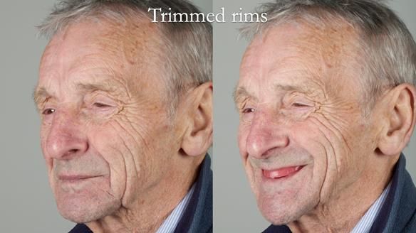 Newsletter 80 - Gordon’s dentures: the one case in 1,000 where my technique failed