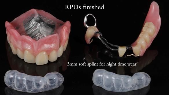 Newsletter 55 Provision of metal based partial dentures for Zephyrine with a repaired cleft lip and palate