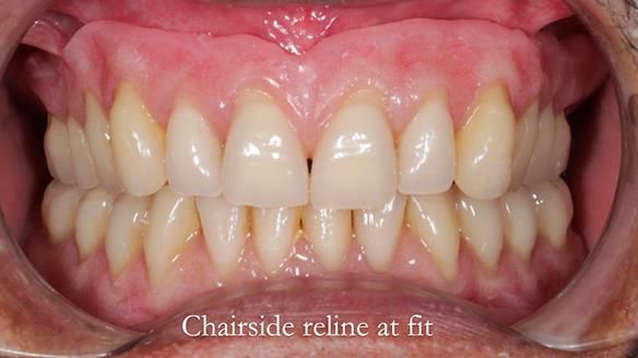 Finlay's Newsletter 62 provision of extractions and metal based complete dentures for Rafique