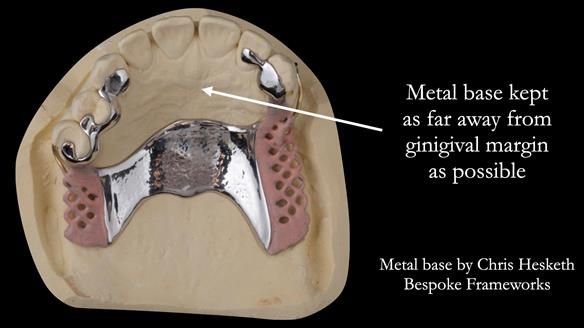 Solving Sue's failed implants with metal based RPD - full protocol Newsletter 43