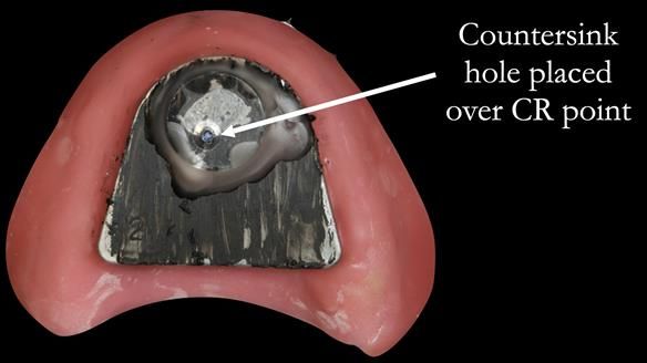 The central bearing apparatus is placed back into the mouth and the lower jaw part is guided into the hole on the upper plate