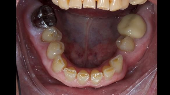 Newsletter 81 - Pam’s Story — how a partial denture changed her life (+ live walkthrough this Thursday)
