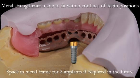 Newsletter 50 Special edition Complete Dentures FULL PROTOCOL