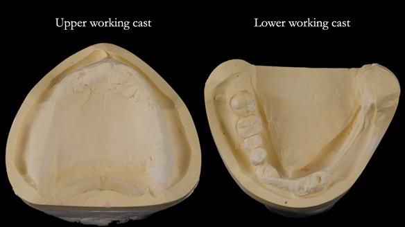 Newsletter 82 Mary - A complete upper and a one-tooth gasket denture
