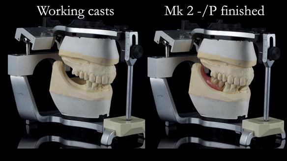 Newsletter 54 case presentation upper complete denture and lower Scandinavian designed hygienic partial denture for David