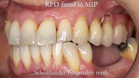 Newsletter 56 showing the making and fitting of a bilateral free end saddle upper removable partial denture (RPD) for patient with pemphigus