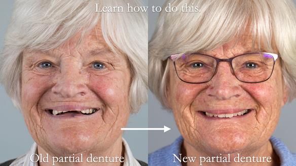 Finlay's Newsletter 59 Ultra hard partial dentures made for Gill