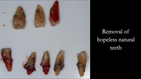 Finlay's Case Study Newsletter 40 - Immediate Mk 1 RPD to Definitive Mk 2 RPD - full protocol