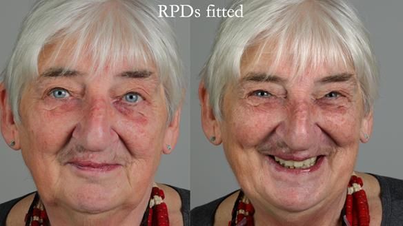 Newsletter 55 Provision of metal based partial dentures for Zephyrine with a repaired cleft lip and palate