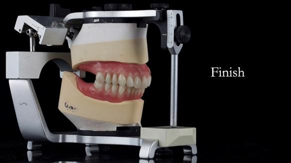 Newsletter 49 Managing Estelle’s failing implants with dentures FULL PROTOCOL