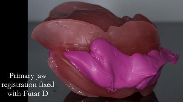 Newsletter 75: Marion’s case - Step-by-step complete denture workflow