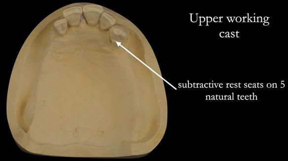Finlay's Case Study Newsletter 40 - Immediate Mk 1 RPD to Definitive Mk 2 RPD - full protocol