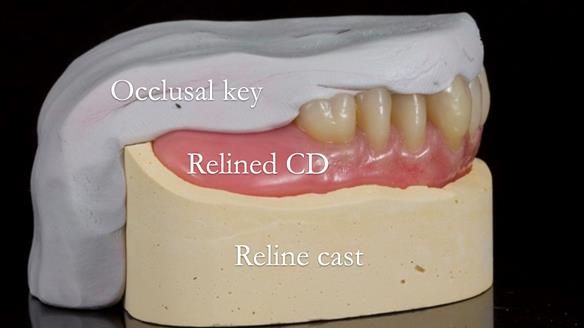 Finlay's Newsletter 62 provision of extractions and metal based complete dentures for Rafique
