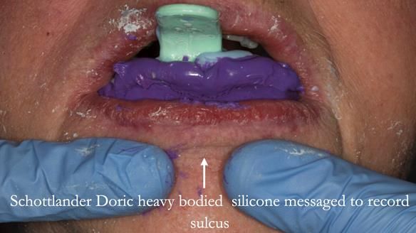 Finlay's Case Study Newsletter 40 - Immediate Mk 1 RPD to Definitive Mk 2 RPD - full protocol