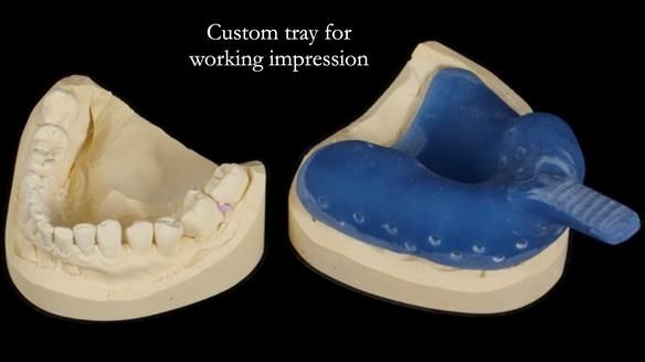 Finlay's Newsletter 64 case study - provision of a Kennedy class 2 metal based Scandinavian RPD for Ian