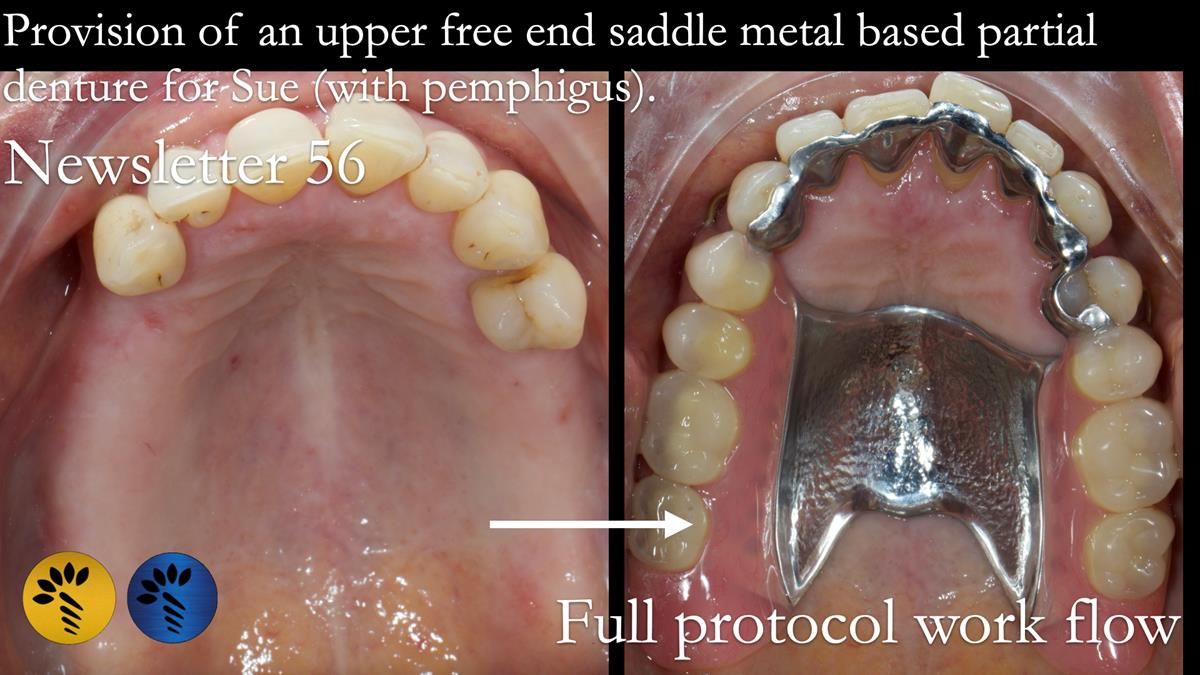 Newsletter 56 showing the making and fitting of a bilateral free end saddle upper removable partial denture (RPD) for patient with pemphigus