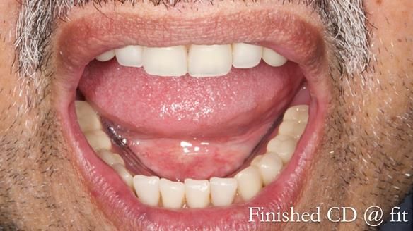 Finlay's Newsletter 62 provision of extractions and metal based complete dentures for Rafique