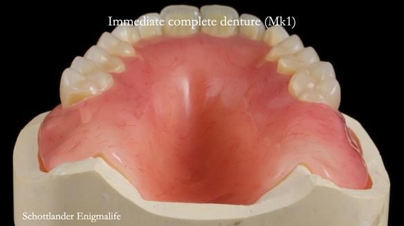 Newsletter 77: Jeremy’s case – immediate complete upper denture