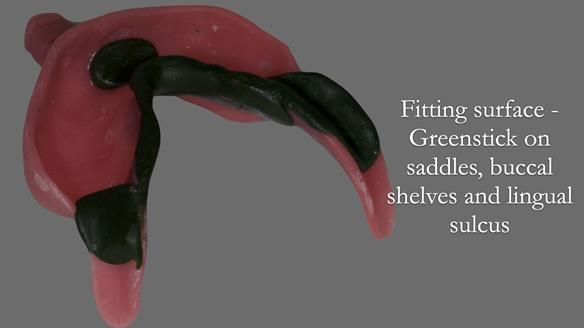 Newsletter 52 Managing Jo’s failing dentition with extractions and Mk 1/Mk 2 complete upper dentures and lower partial dentures FULL PROTOCOL