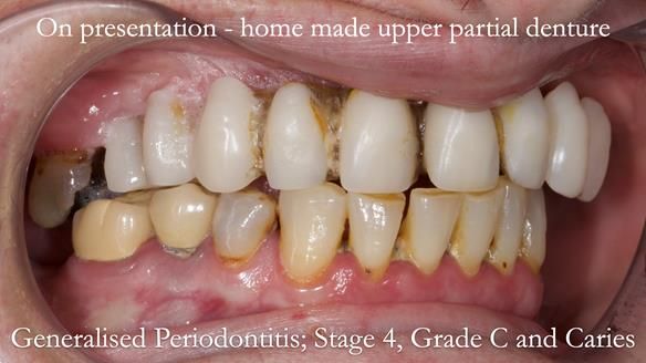 Newsletter 52 Managing Jo’s failing dentition with extractions and Mk 1/Mk 2 complete upper dentures and lower partial dentures FULL PROTOCOL