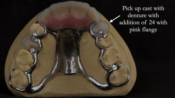 Finlay's Newsletter 63 Case study provision of metal based Scandinavian RPD - functional 10 years on
