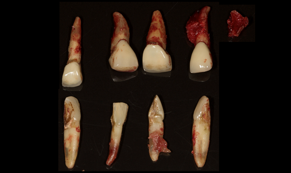 Figure 25 Extracted teeth