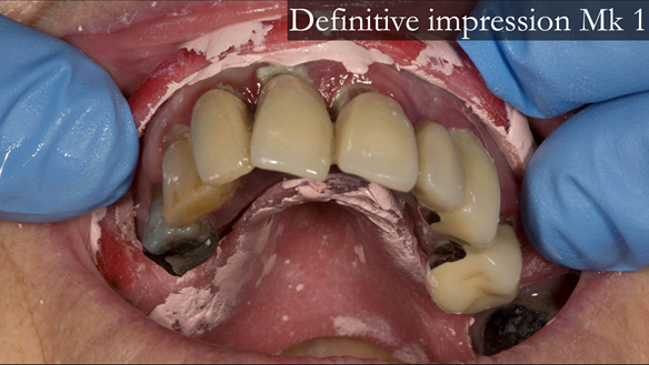 Figure 18 Definitive impression placed back into the mouth
