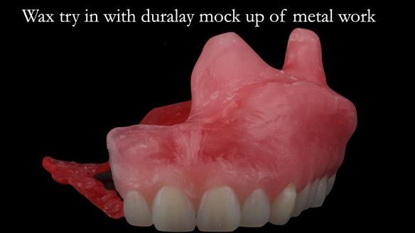 Upper metal base partial denture/occlusal stabilisation splint/obturator - full protocol