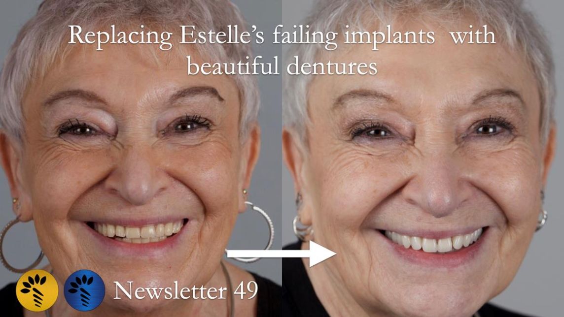 Newsletter 49 Managing Estelle’s failing implants with dentures FULL PROTOCOL