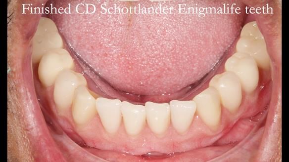 Finlay's Newsletter 62 provision of extractions and metal based complete dentures for Rafique