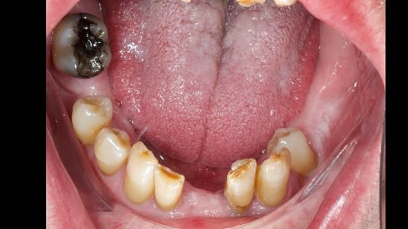Newsletter 86 Peter the Architect — precision removable partial dentures case study