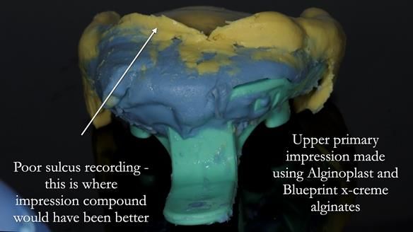 Newsletter 83: Sheila’s Complete Denture Success