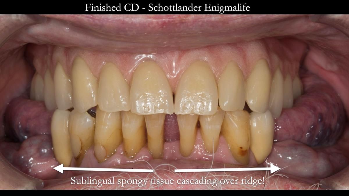 Newsletter 87 – Father Peter: A Partial Denture that needed Minor Miracle