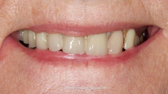 Newsletter 82 Mary - A complete upper and a one-tooth gasket denture