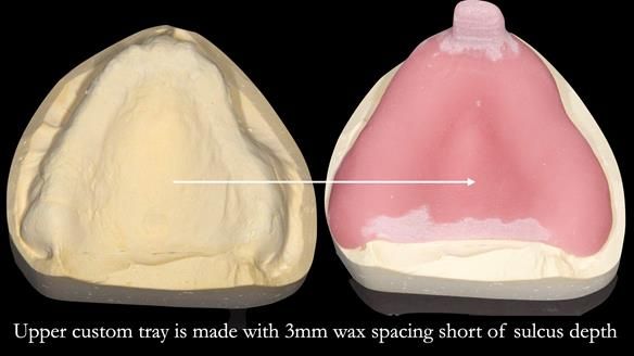 Newsletter 54 case presentation upper complete denture and lower Scandinavian designed hygienic partial denture for David