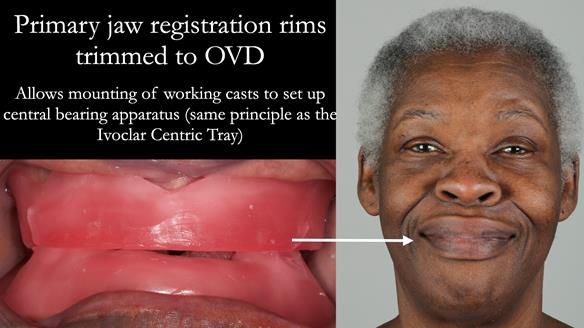 Newsletter 53 showing the making and fitting of ultra life-like dentures for Valena