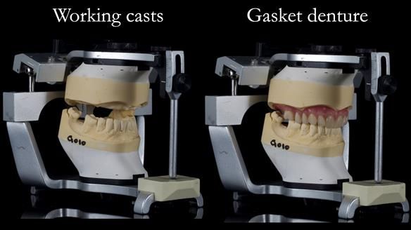 Finlay's Newsletter 58 Gasket upper partial denture for Zoe